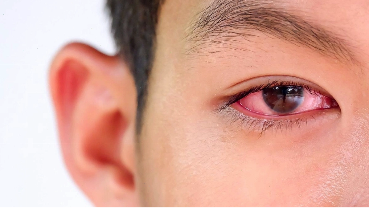 Tổng quan bệnh Viêm kết mạc đau mắt đỏ