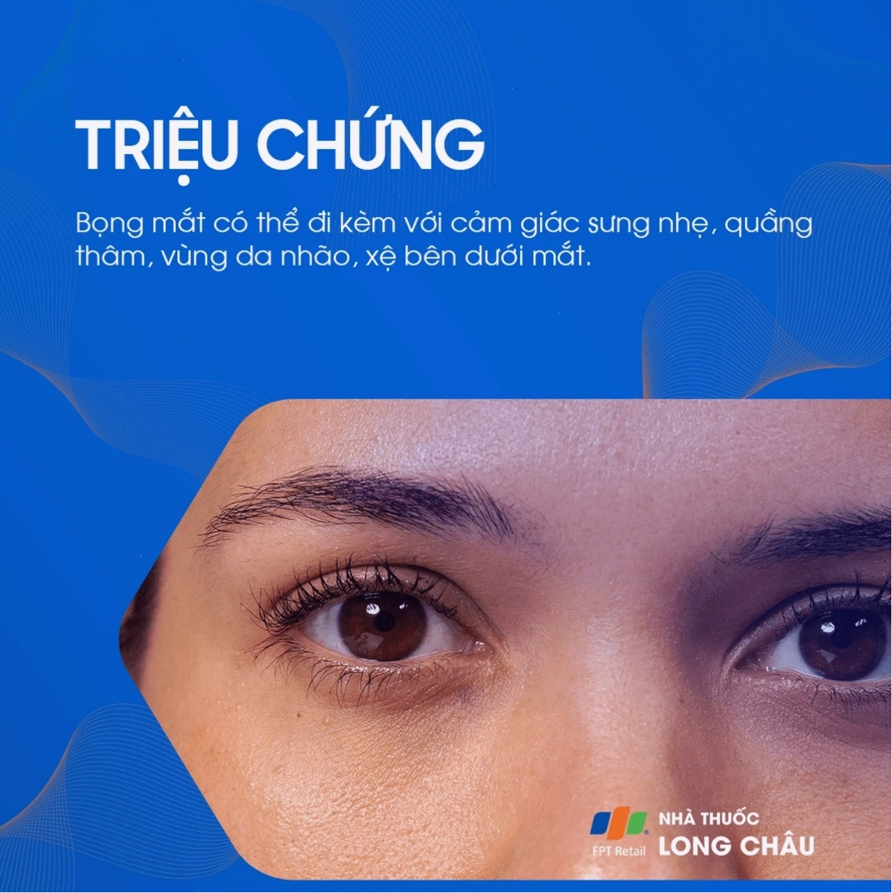 Triệu chứng bọng mắt: Sưng phù và bầm dưới mắt