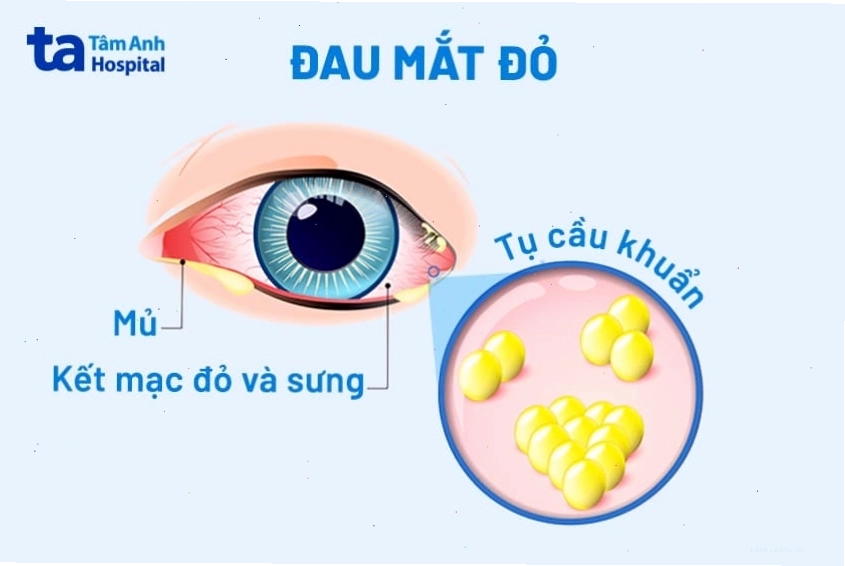 Triệu chứng đỏ mắt, chảy nước mắt và cộm mắt là dấu hiệu phổ biến của đau mắt đỏ