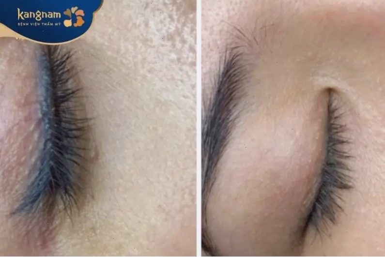Trước và sau xóa xăm mí mắt: Làn da phục hồi mịn màng tự nhiên