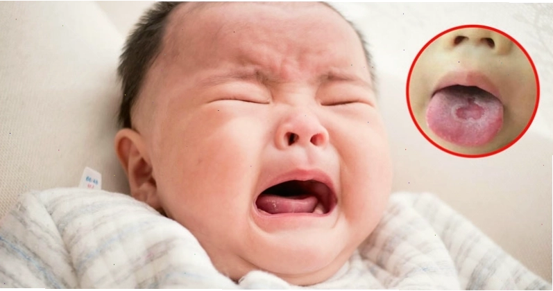 Tưa lưỡi là bệnh nhiễm nấm phổ biến do Candida albicans gây ra