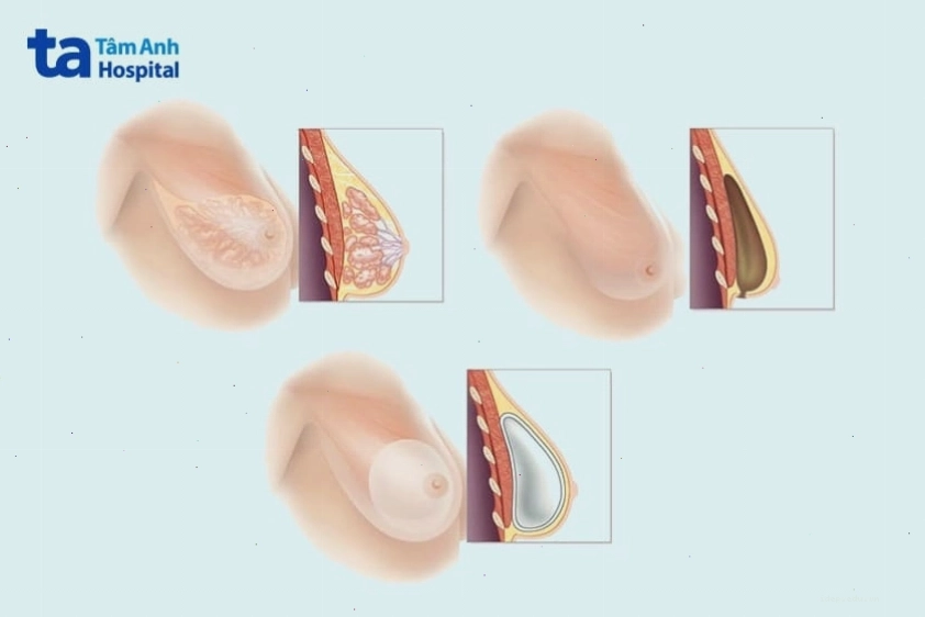 Túi ngực và ảnh hưởng đến nguồn sữa mẹ