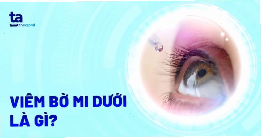 Vệ sinh mắt kém là một trong những nguyên nhân gây viêm bờ mi