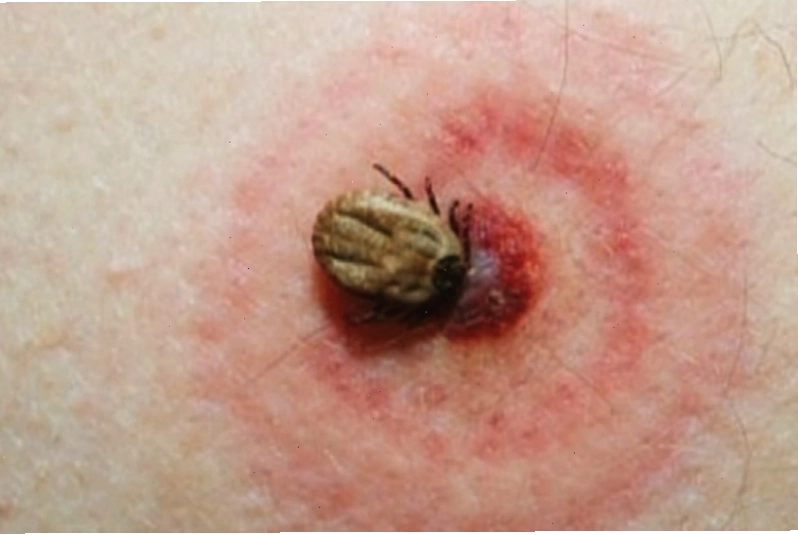 Vết mẩn đỏ hình vòng tròn đặc trưng của bệnh Lyme sau khi bị ve đốt