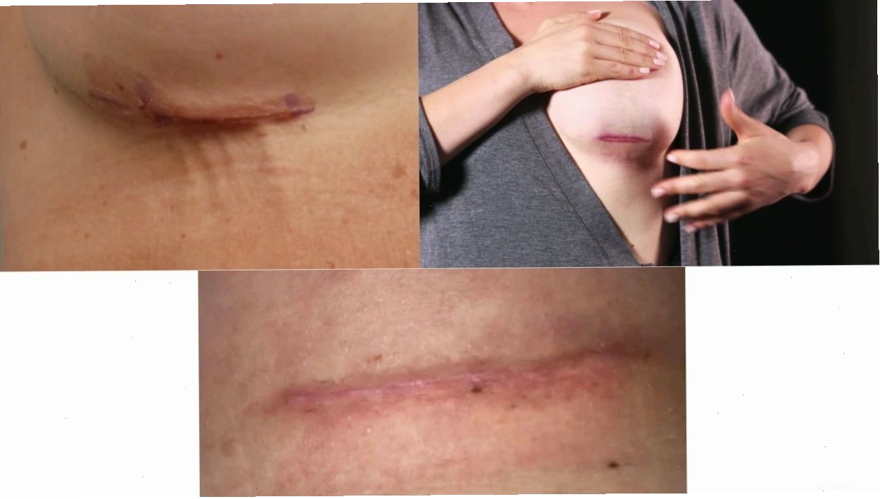 Vết mổ chuyển thâm tím sau phẫu thuật