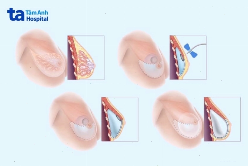 Việc đặt túi ngực có thể ảnh hưởng đến nguồn sữa mẹ nếu không được chăm sóc đúng cách