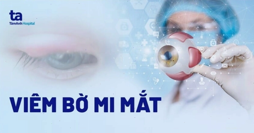 Viêm mí mắt gây sưng đỏ và khó chịu