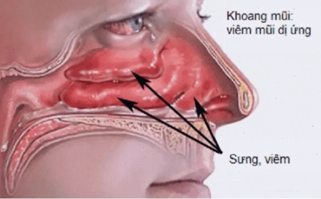 Viêm mũi dị ứng làm tăng nguy cơ xuất hiện polyp mũi