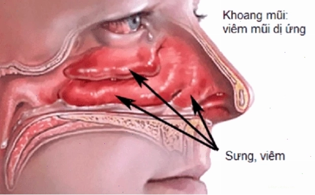 Viêm mũi dị ứng làm tăng nguy cơ xuất hiện polyp mũi