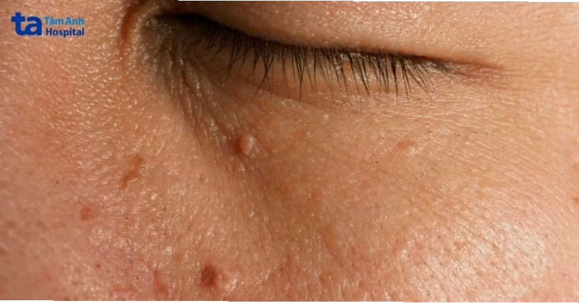 Vùng da phía dưới mắt bị mụn thịt làm giảm thẩm mỹ
