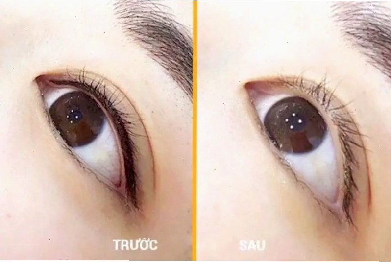 Xóa xăm mí mắt thành công, không để lại sẹo hay thâm