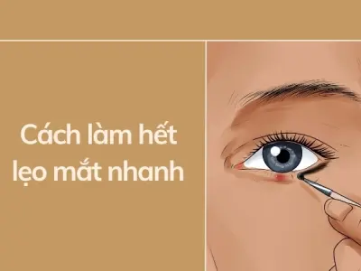 Cách làm hết lẹo mắt nhanh và an toàn, hiệu quả