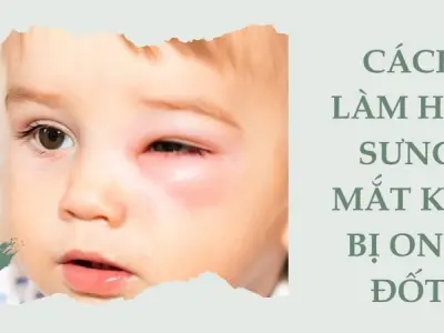 Cách làm hết sưng mắt khi bị ong đốt đơn giản, an toàn
