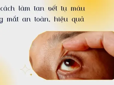 Bật mí cách làm tan vết tụ máu trong mắt tại nhà