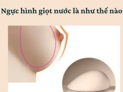 Ngực hình giọt nước là như thế nào? Tại sao nhiều người thích?