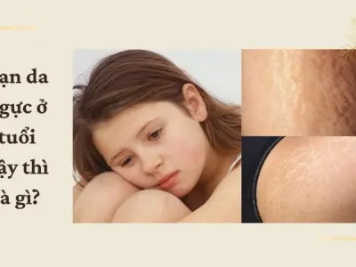 Làm thế nào để hạn chế rạn da ngực ở tuổi dậy thì?