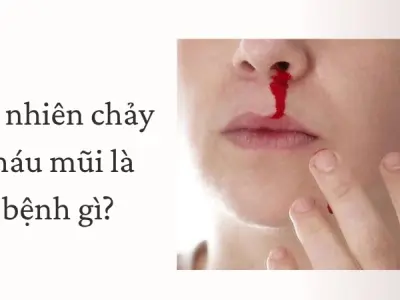 Nguyên nhân tự nhiên chảy máu mũi là bệnh gì?