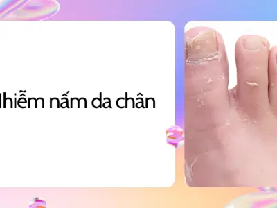 Cách chữa nhiễm nấm da chân hiệu quả, dứt điểm ngay tại nhà