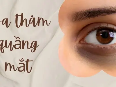Xóa thâm quầng mắt đúng cách mang lại vẻ ngoài tươi trẻ