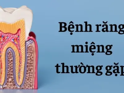Bệnh răng miệng thường gặp do thói quen thuộc hằng ngày