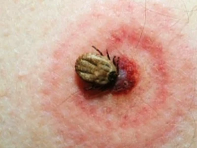 Bệnh Lyme là gì? Nguyên nhân, triệu chứng và cách phòng ngừa chi tiết