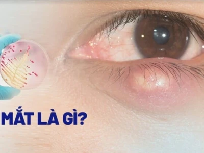 Bị nổi lẹo mắt: Nguyên nhân, dấu hiệu và cách xử lý hiệu quả