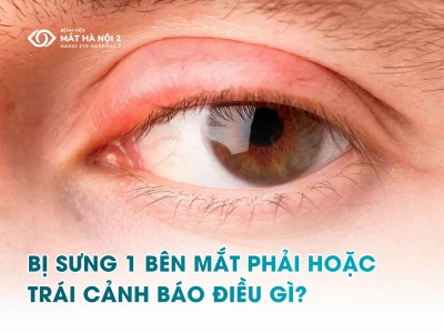 Bọng mắt bị sưng một bên: Nguyên nhân, dấu hiệu và cách khắc phục hiệu quả