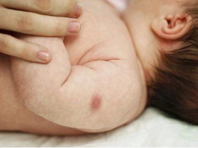 Chích mũi lao bao lâu thì mưng mủ và những điều cần biết