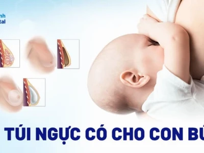 Đặt túi ngực có cho con bú được không? Phân tích chuyên sâu