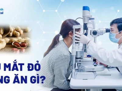 Đau mắt đỏ kiêng ăn gì và những thực phẩm cần tránh để mau khỏi bệnh