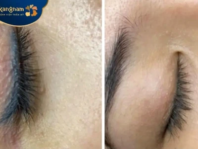 Hình ảnh sau khi xóa xăm mí mắt: Kỳ vọng và thực tế