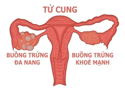 Hội chứng buồng trứng đa nang là gì? Nguyên nhân, dấu hiệu và cách điều trị