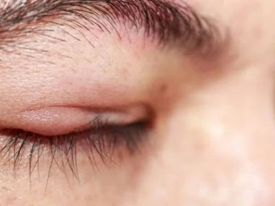 Mắt Tự Nhiên Bị Đỏ Không Đau: Nguyên Nhân và Cách Xử Lý