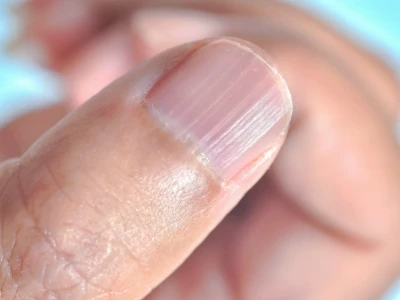 Móng tay có sọc dọc là bệnh gì và dấu hiệu cảnh báo sức khỏe