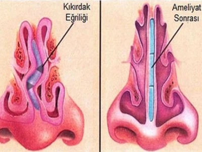 Mũi lệch vách ngăn: Nguyên nhân, dấu hiệu và cách khắc phục hiệu quả