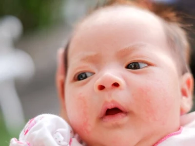Mụn sữa ở trẻ sơ sinh: Nên tắm lá gì để làm dịu làn da nhạy cảm?
