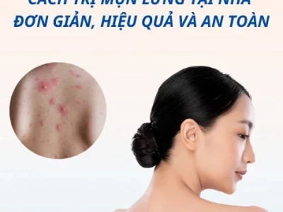 Nguyên nhân nổi mụn lưng và cách khắc phục hiệu quả
