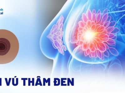 Núm vú thâm đen: Nguyên nhân và giải pháp khắc phục hiệu quả 2026