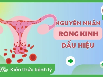 Rong Kinh Là Gì? Nguyên Nhân, Dấu Hiệu Và Cách Điều Trị Hiệu Quả Năm 2026