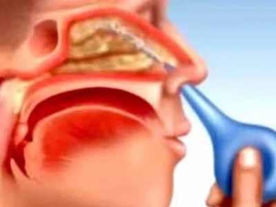 Rửa mũi bị đau tai ở người lớn: Nguyên nhân, cách xử lý và phòng ngừa