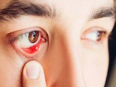 Sạn vôi trong mắt: Chi phí lấy sạn vôi và các phương pháp điều trị