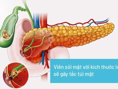 Sỏi mật là gì? Nguyên nhân, dấu hiệu nhận biết và cách điều trị hiệu quả