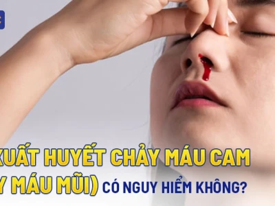 Sốt Xuất Huyết Chảy Máu Mũi: Dấu Hiệu Nguy Hiểm Cần Nhận Biết