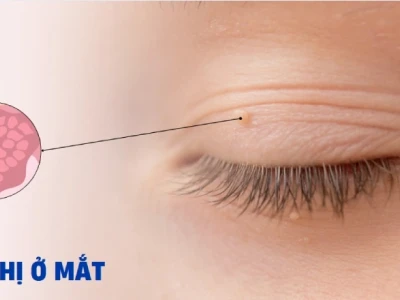 Trị mụn thịt quanh mắt: Nguyên nhân, cách điều trị và phòng ngừa hiệu quả