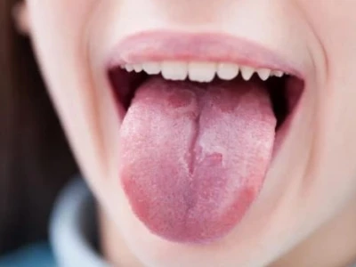 Tưa lưỡi là gì? Nguyên nhân, dấu hiệu nhận biết và cách điều trị hiệu quả
