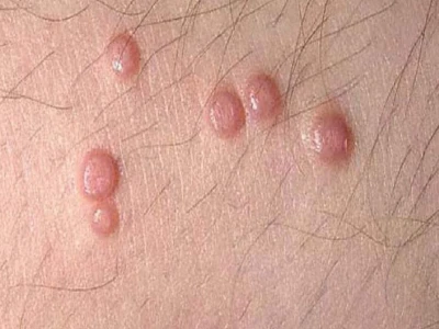 U nhú sinh dục là gì? Phân biệt lành tính và ác tính, phương pháp điều trị