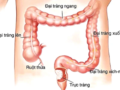 Viêm đại tràng: Nguyên nhân, triệu chứng và cách điều trị hiệu quả