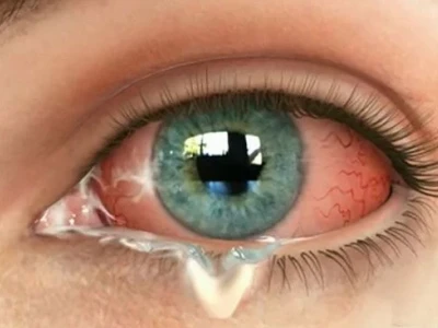 Viêm kết mạc mắt là gì? Nguyên nhân, triệu chứng và cách điều trị