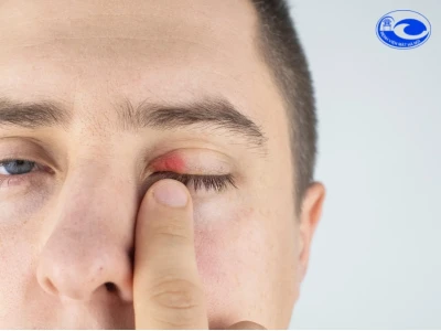 Viêm mí mắt là gì? Nguyên nhân, triệu chứng và cách điều trị hiệu quả
