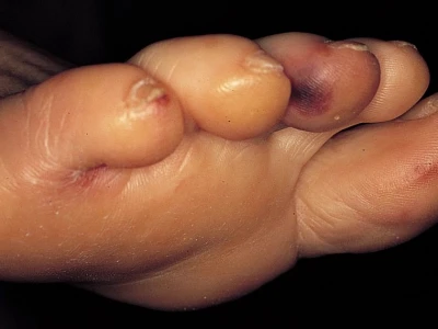 Viêm nội tâm mạc là gì? Triệu chứng, nguyên nhân và cách phòng ngừa